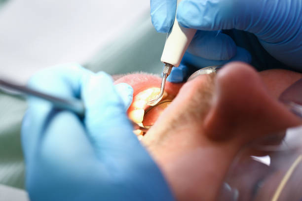 Best Emergency Dentist for Lost Fillings or Crowns in North Vernon, IN
